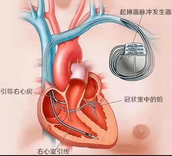 百多力起搏器怎么样迎新春丨我院心脏起搏器程控门诊全面升级_https://www.jmylbn.com_新闻资讯_第10张