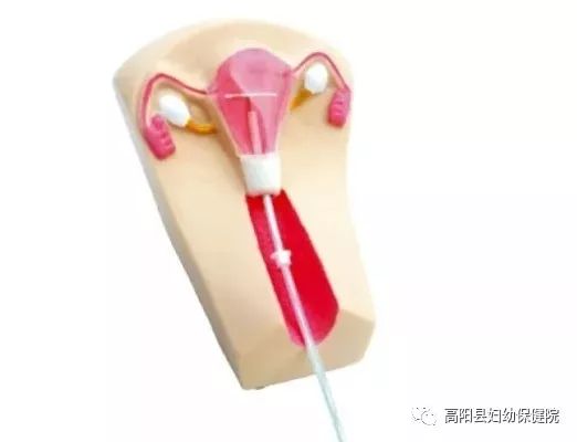 免费取环和上环政策宣传_取环国家免费吗_国家免费取环政策