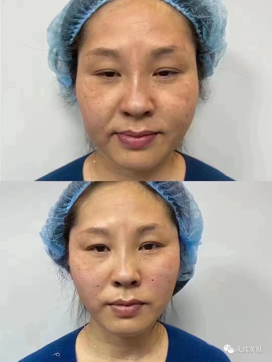 国械注进怎么查美思科蛋白线《国械注进》型号，规格，术后注意事项及详解_https://www.jmylbn.com_新闻资讯_第6张