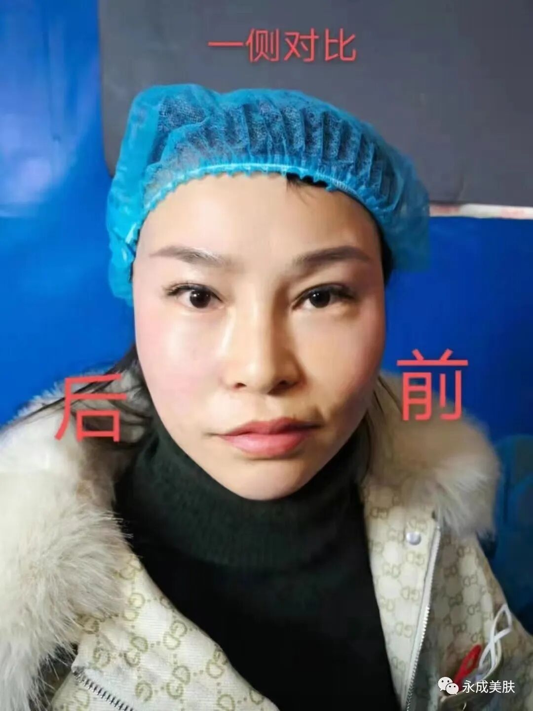 国械注进怎么查美思科蛋白线《国械注进》型号，规格，术后注意事项及详解_https://www.jmylbn.com_新闻资讯_第8张