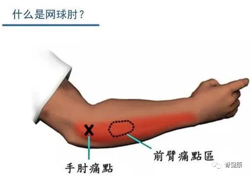 网球肘干货解析，防治与康复同样重要！