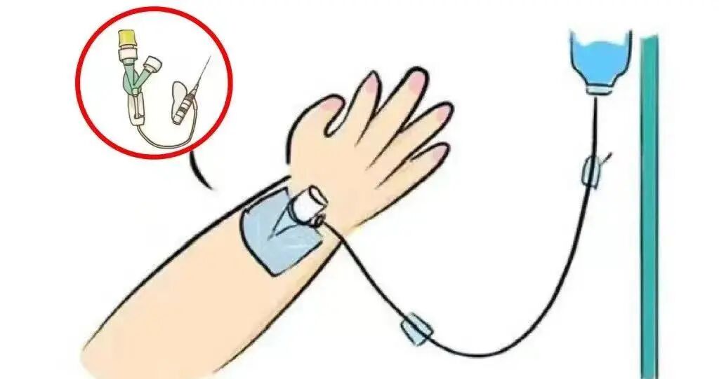 bd留置针怎么使用【宝宝输液小助手】留置针的正确打开方式——家长必备攻略_https://www.jmylbn.com_新闻资讯_第13张