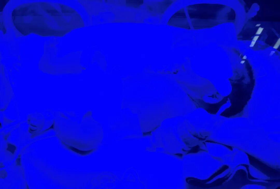 为什么要用光疗纸尿裤【贴心服务】我院儿科开展新生儿病理性黄疸日间光疗诊疗服务_https://www.jmylbn.com_新闻资讯_第1张