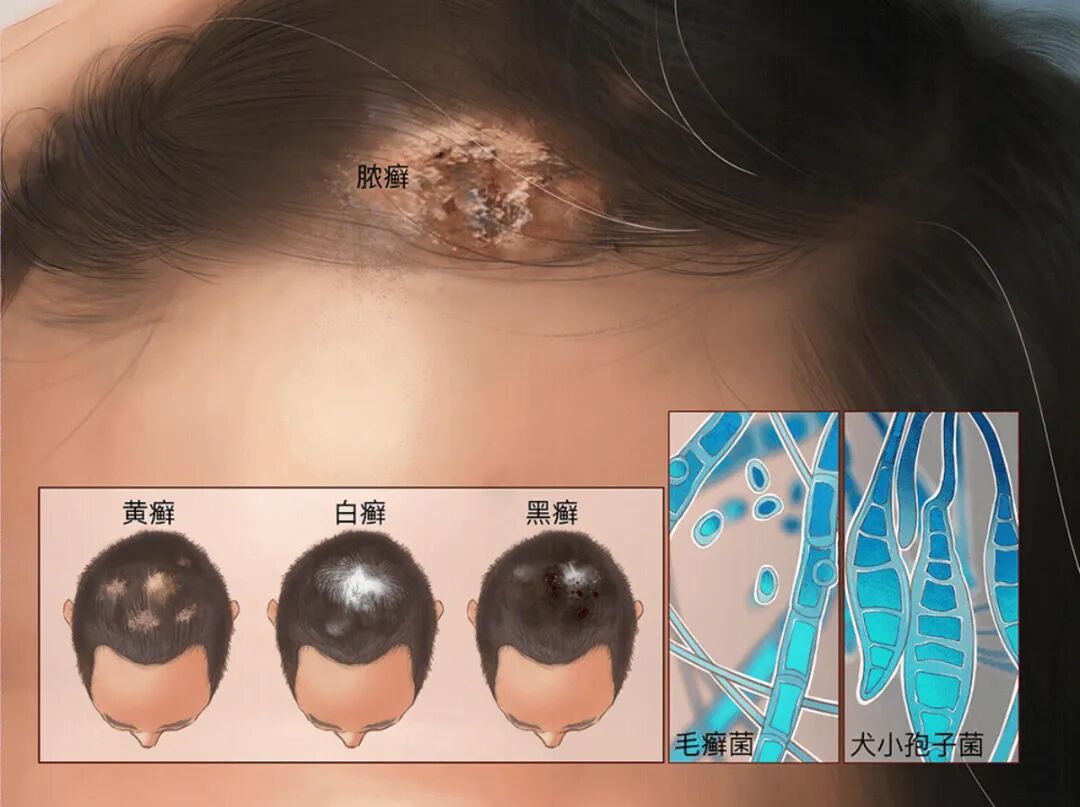 头癣的表现、治疗以及楚迪临床治疗效果