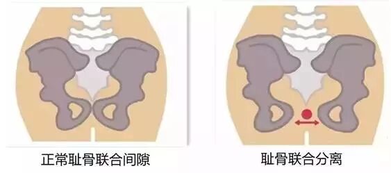 产后有一种痛叫“耻骨联合分离”
