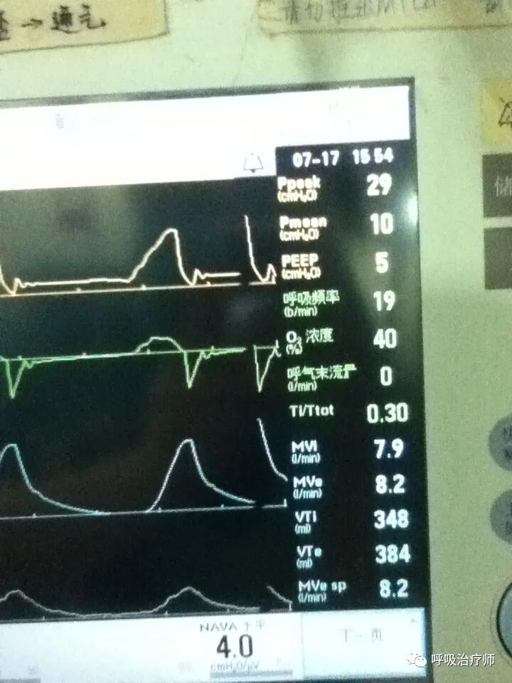 呼吸机模式怎么调节呼吸机模式-NAVA／MMV_https://www.jmylbn.com_新闻资讯_第8张