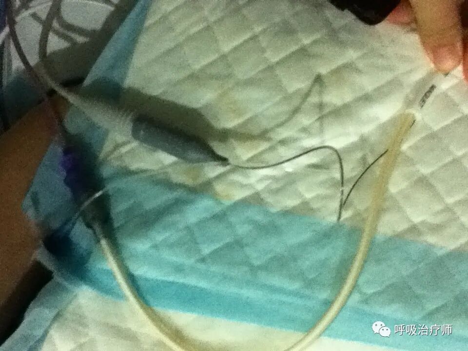 呼吸机模式怎么调节呼吸机模式-NAVA／MMV_https://www.jmylbn.com_新闻资讯_第6张