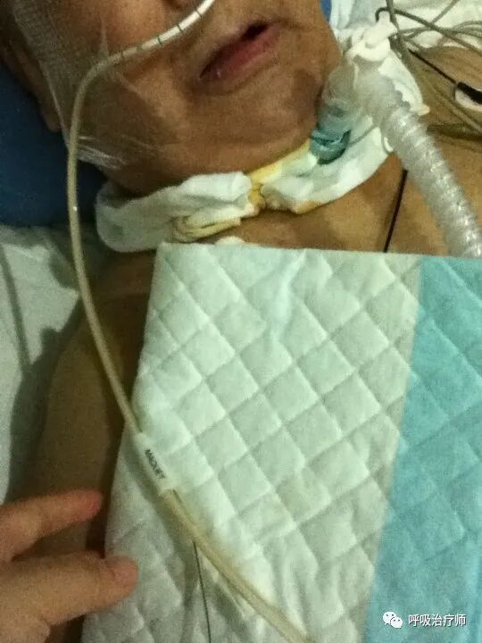 呼吸机模式怎么调节呼吸机模式-NAVA／MMV_https://www.jmylbn.com_新闻资讯_第5张