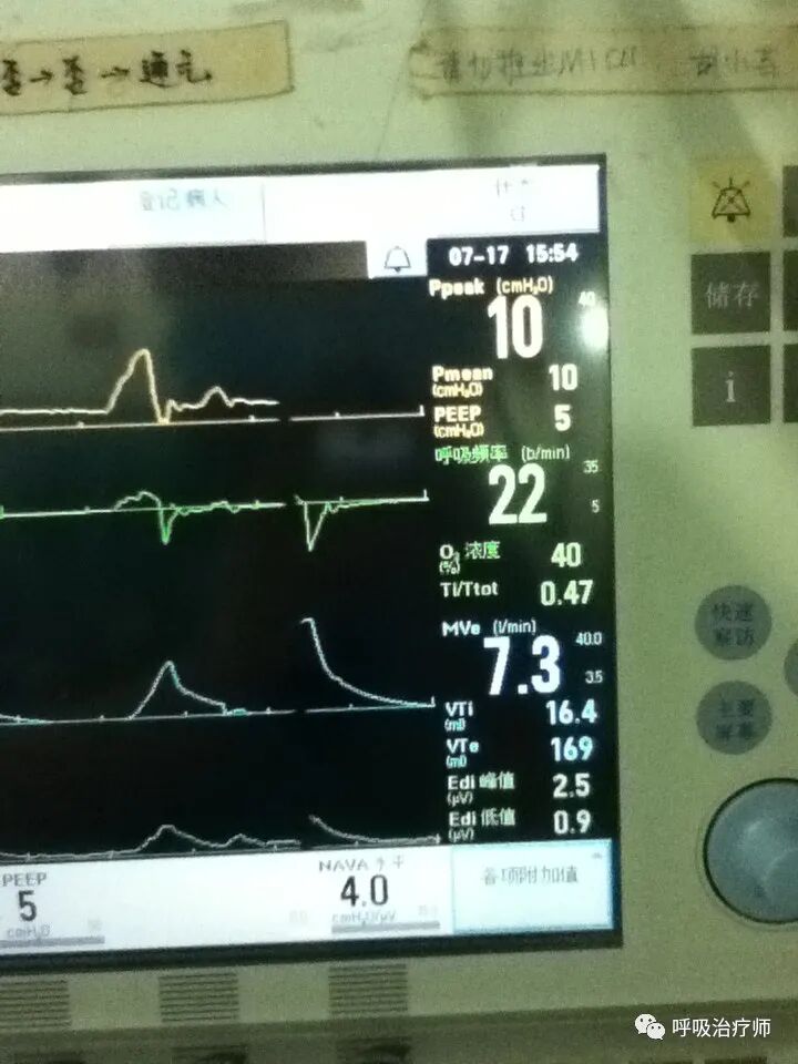 呼吸机模式怎么调节呼吸机模式-NAVA／MMV_https://www.jmylbn.com_新闻资讯_第7张