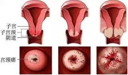 如何預防宮頸癌？ 健康 第3張