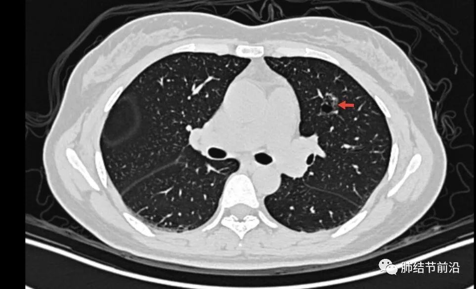 肺結節讀片容易忽視的囊腔樣肺腺癌的ct特點