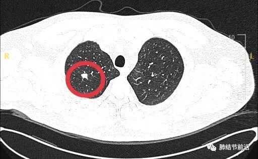 肺结节读片:这就是实性结节的「边界毛糙」_医学界-助力医生临床决策