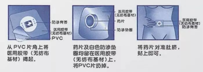 痔疮给药器怎么用如何正确使用各类痔疮药？_https://www.jmylbn.com_新闻资讯_第21张