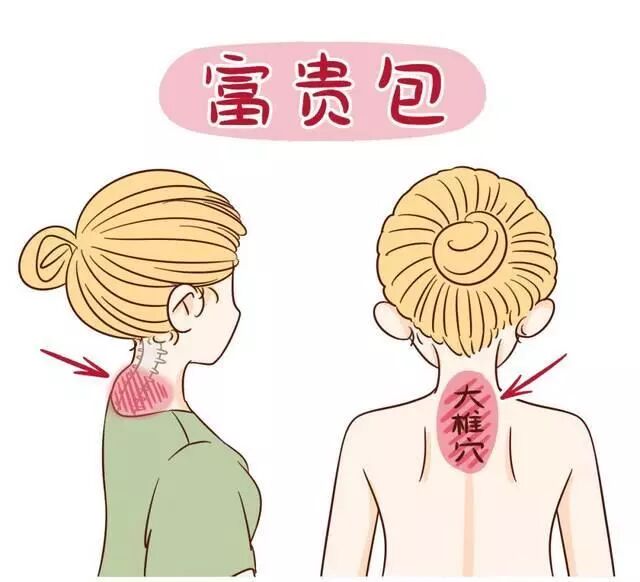 古法经络|“富贵包”是如何形成的？能消除吗？