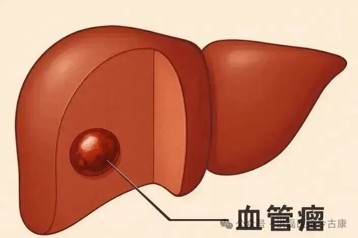 肝血管瘤秘方