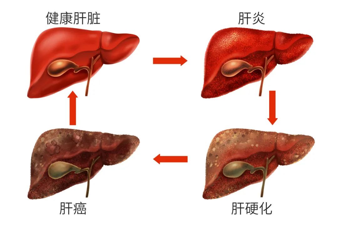 肝癌图片传染图片