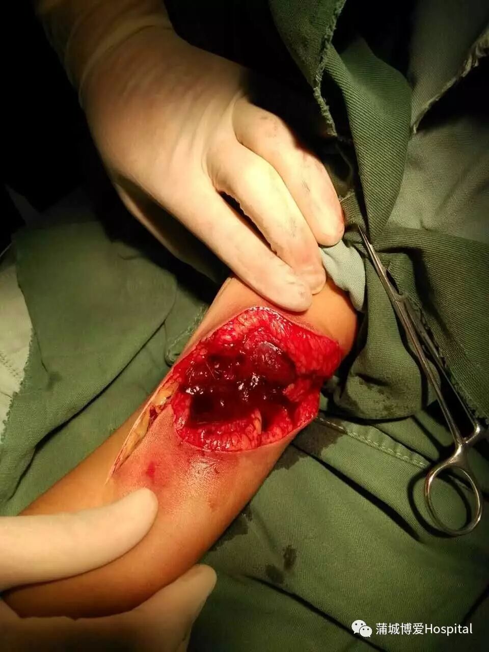 手外伤案例——左肘部清创,血管,神经,肌腱探查修复术