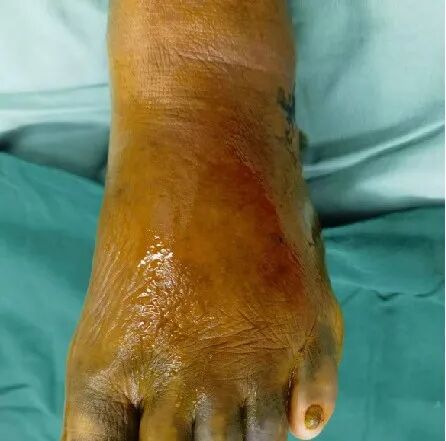 为什么负压引流VSD负压封闭引流术的护理_https://www.jmylbn.com_新闻资讯_第4张