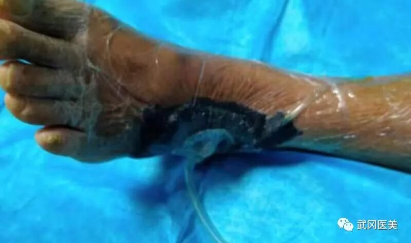 为什么负压引流VSD负压封闭引流术的护理_https://www.jmylbn.com_新闻资讯_第6张