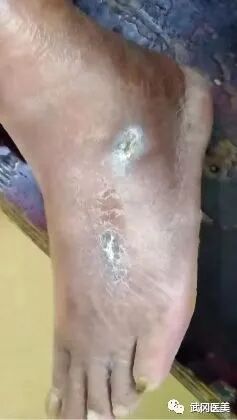 为什么负压引流VSD负压封闭引流术的护理_https://www.jmylbn.com_新闻资讯_第8张