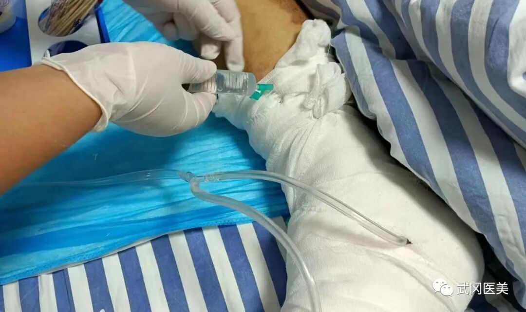 为什么负压引流VSD负压封闭引流术的护理_https://www.jmylbn.com_新闻资讯_第3张