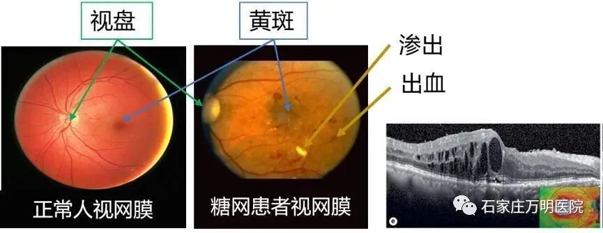 干货分享 科学认识糖尿病眼底病变 向失明说 不 糖尿病眼底病变 石家庄万明医院