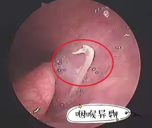 喉镜是什么科耳鼻喉科电子纤维喉镜检查，让早期病变“无处藏身”_https://www.jmylbn.com_新闻资讯_第11张