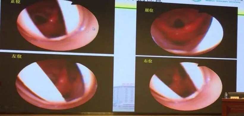 喉镜是什么科耳鼻喉科电子纤维喉镜检查，让早期病变“无处藏身”_https://www.jmylbn.com_新闻资讯_第13张