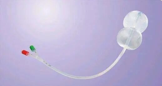 cook球囊怎么取超预产期不发动？COOK球囊来帮忙_https://www.jmylbn.com_新闻资讯_第5张