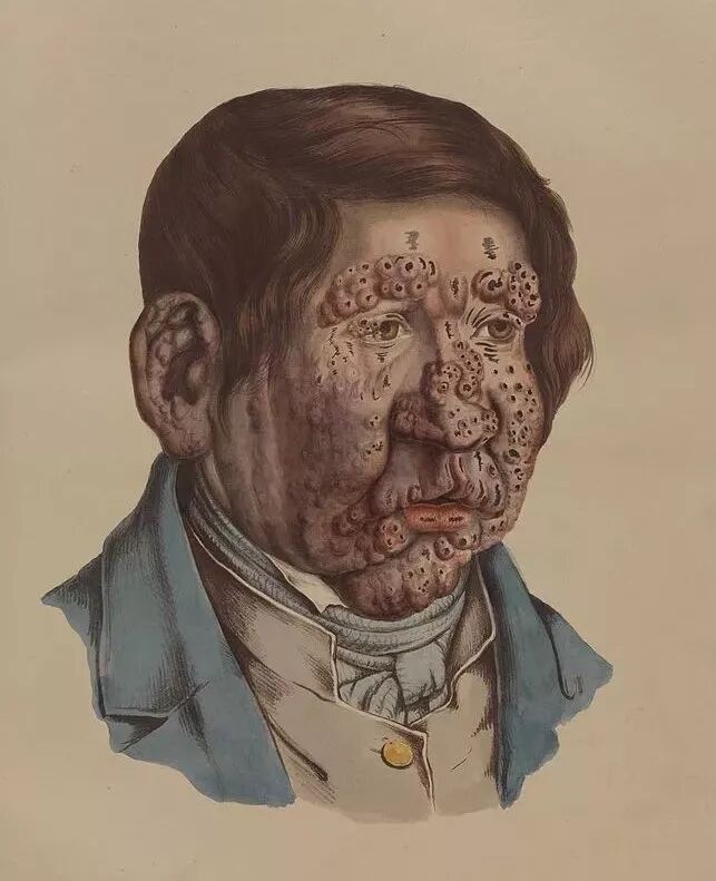 怪病传染性不如流感却能使人毁容致残一生困于恐怖的歧视