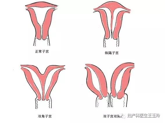 不孕、流產、早產，你有想過自己的子宮異於常人嗎？ 親子 第1張