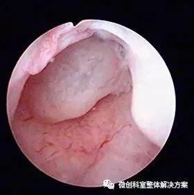 子宫内膜增生宫腔镜图片