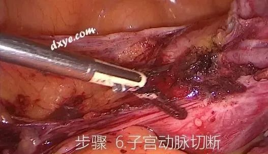 【妇科腹腔镜篇】子宫切除术 【妇科腹腔镜篇】子宫切除术