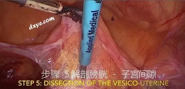 【妇科腹腔镜篇】子宫切除术 【妇科腹腔镜篇】子宫切除术