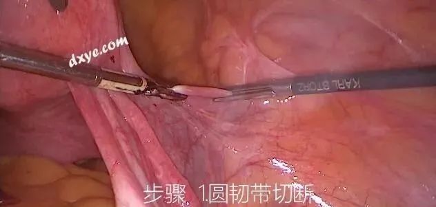 【妇科腹腔镜篇】子宫切除术 【妇科腹腔镜篇】子宫切除术