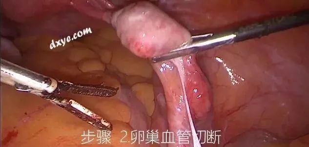 【妇科腹腔镜篇】子宫切除术 【妇科腹腔镜篇】子宫切除术