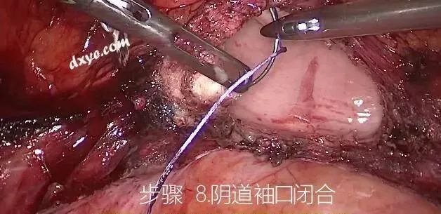 【妇科腹腔镜篇】子宫切除术 【妇科腹腔镜篇】子宫切除术