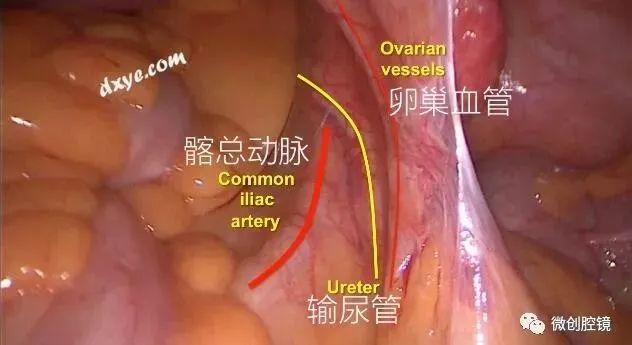 【妇科腹腔镜篇】子宫切除术 【妇科腹腔镜篇】子宫切除术