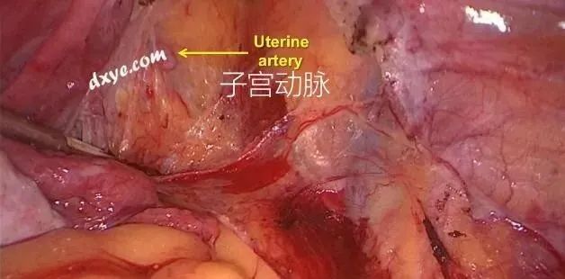 【妇科腹腔镜篇】子宫切除术 【妇科腹腔镜篇】子宫切除术