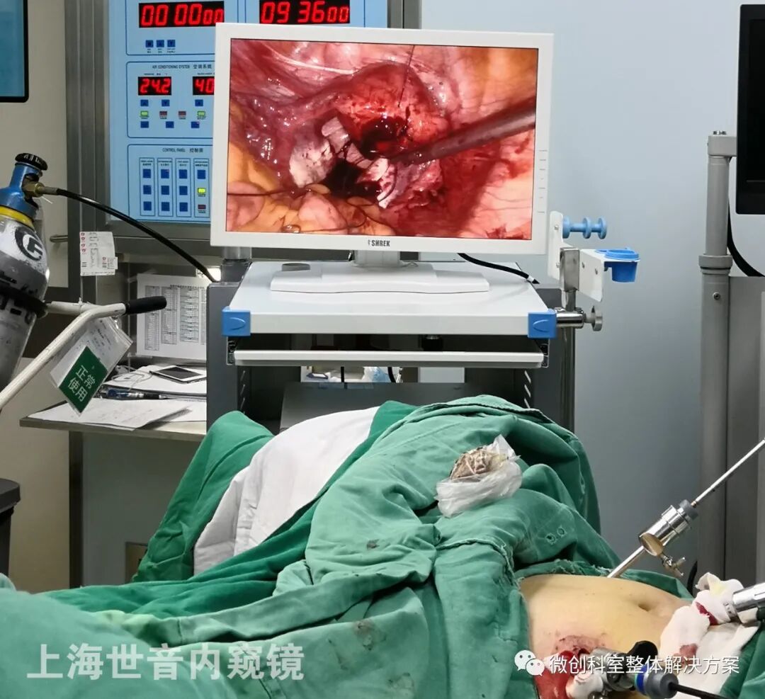 妇科腹腔镜篇穿刺孔