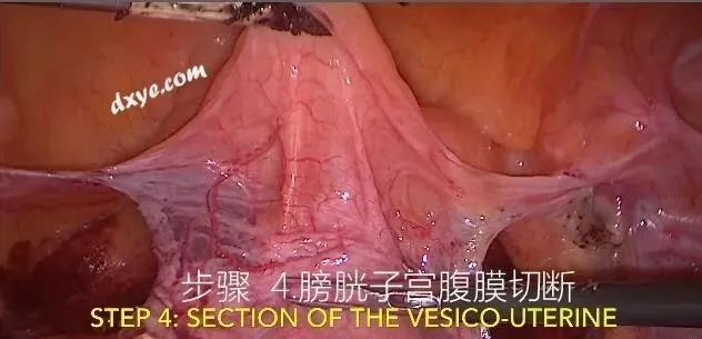 【妇科腹腔镜篇】子宫切除术 【妇科腹腔镜篇】子宫切除术