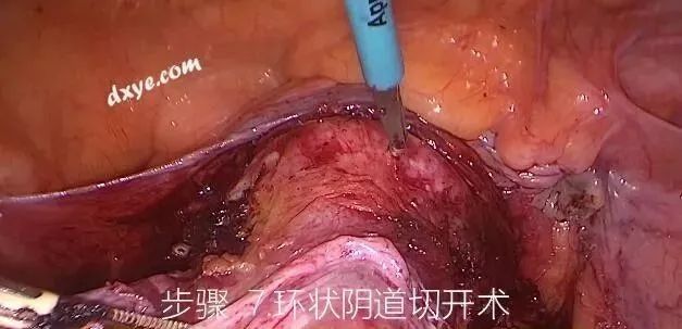 【妇科腹腔镜篇】子宫切除术 【妇科腹腔镜篇】子宫切除术
