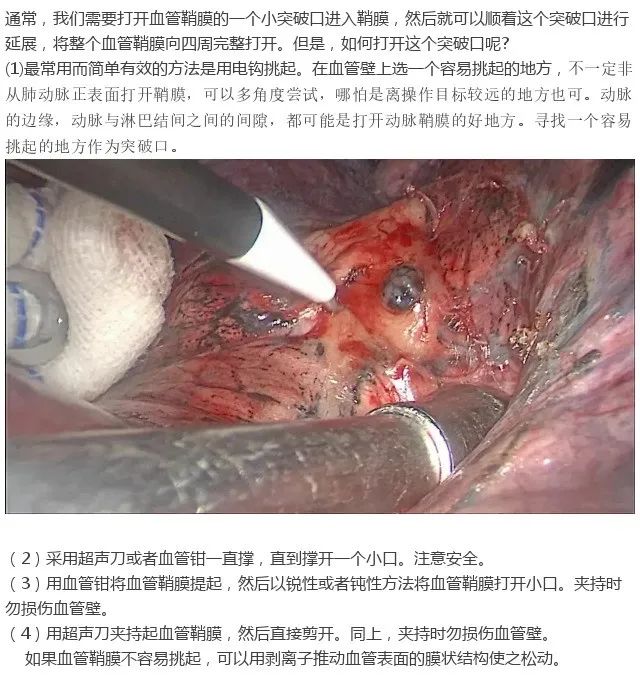 【胸腔镜篇】血管游离裸化技术 【胸腔镜篇】血管游离裸化技术
