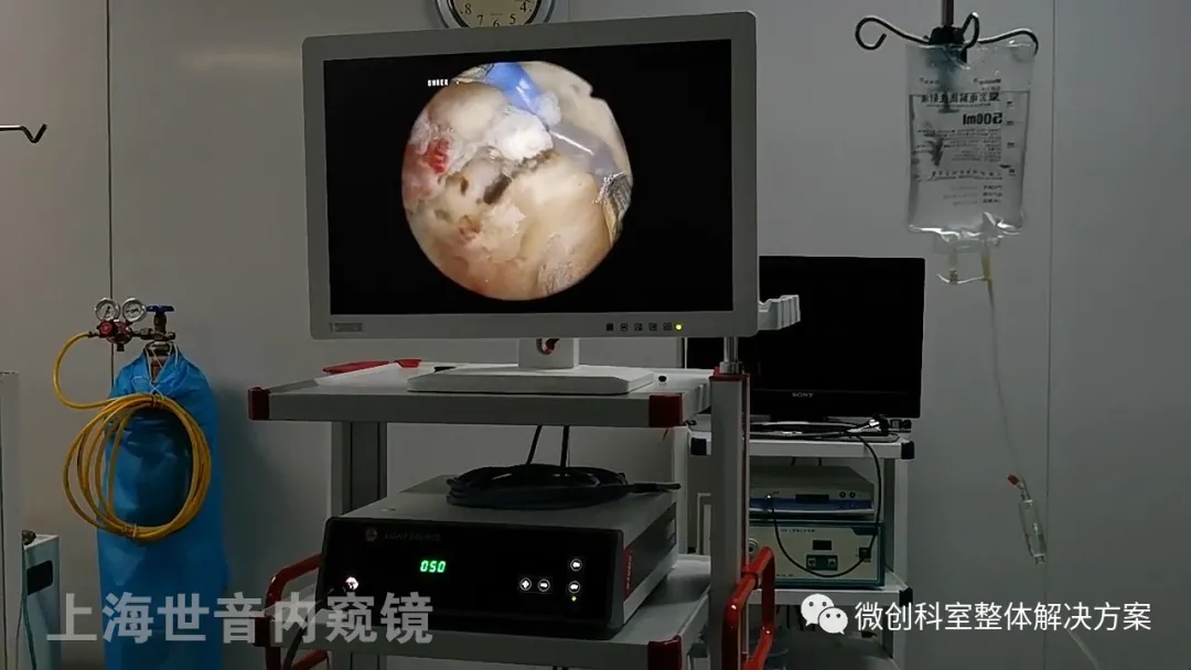 【宫腔镜篇】宫腔镜检查及手术 【宫腔镜篇】宫腔镜检查及手术