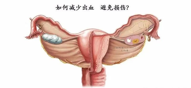【腹腔镜篇】全子宫切除术手术技巧 【腹腔镜篇】全子宫切除术手术技巧