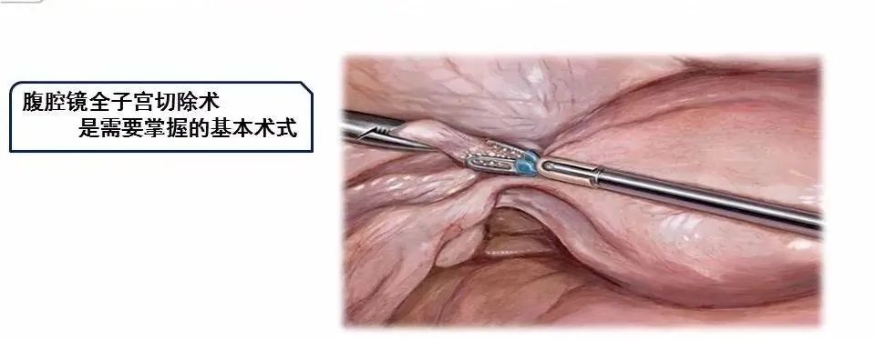 【腹腔镜篇】全子宫切除术手术技巧 【腹腔镜篇】全子宫切除术手术技巧