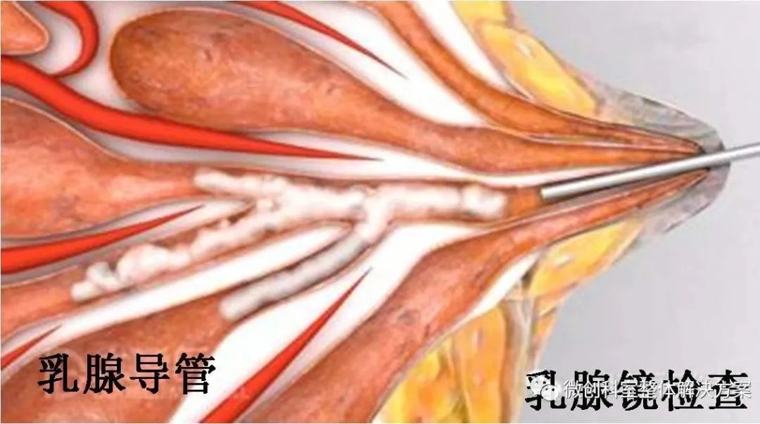 【科普】纤维乳腺内窥镜整体解决方案 【科普】纤维乳腺内窥镜整体解决方案