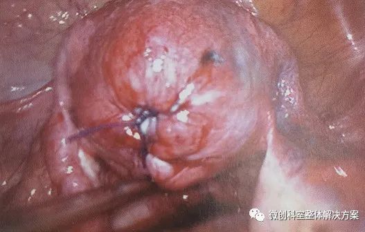 【妇科腹腔镜篇】子宫肌瘤剥除术 【妇科腹腔镜篇】子宫肌瘤剥除术