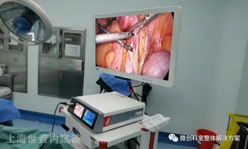 盆腔淋巴结清扫步骤01步骤一麻醉成功后,取下腹正中或旁正中切口,切口