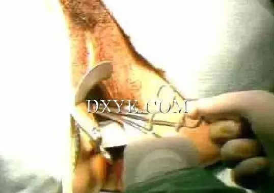 【宫腔镜篇】粘膜下肌瘤宫腔镜电切术 【宫腔镜篇】粘膜下肌瘤宫腔镜电切术